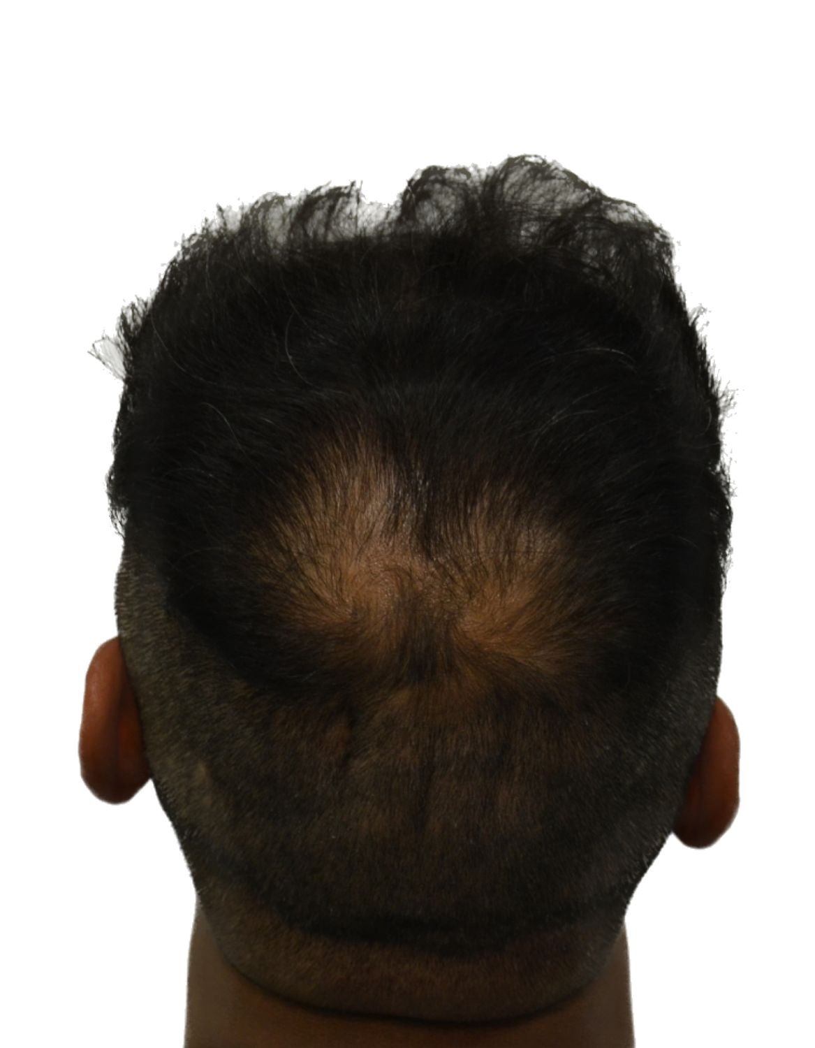 hair transplant before