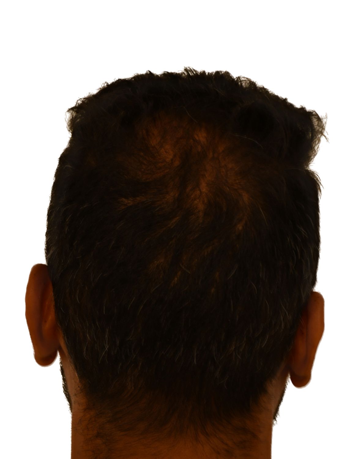 hair transplant after