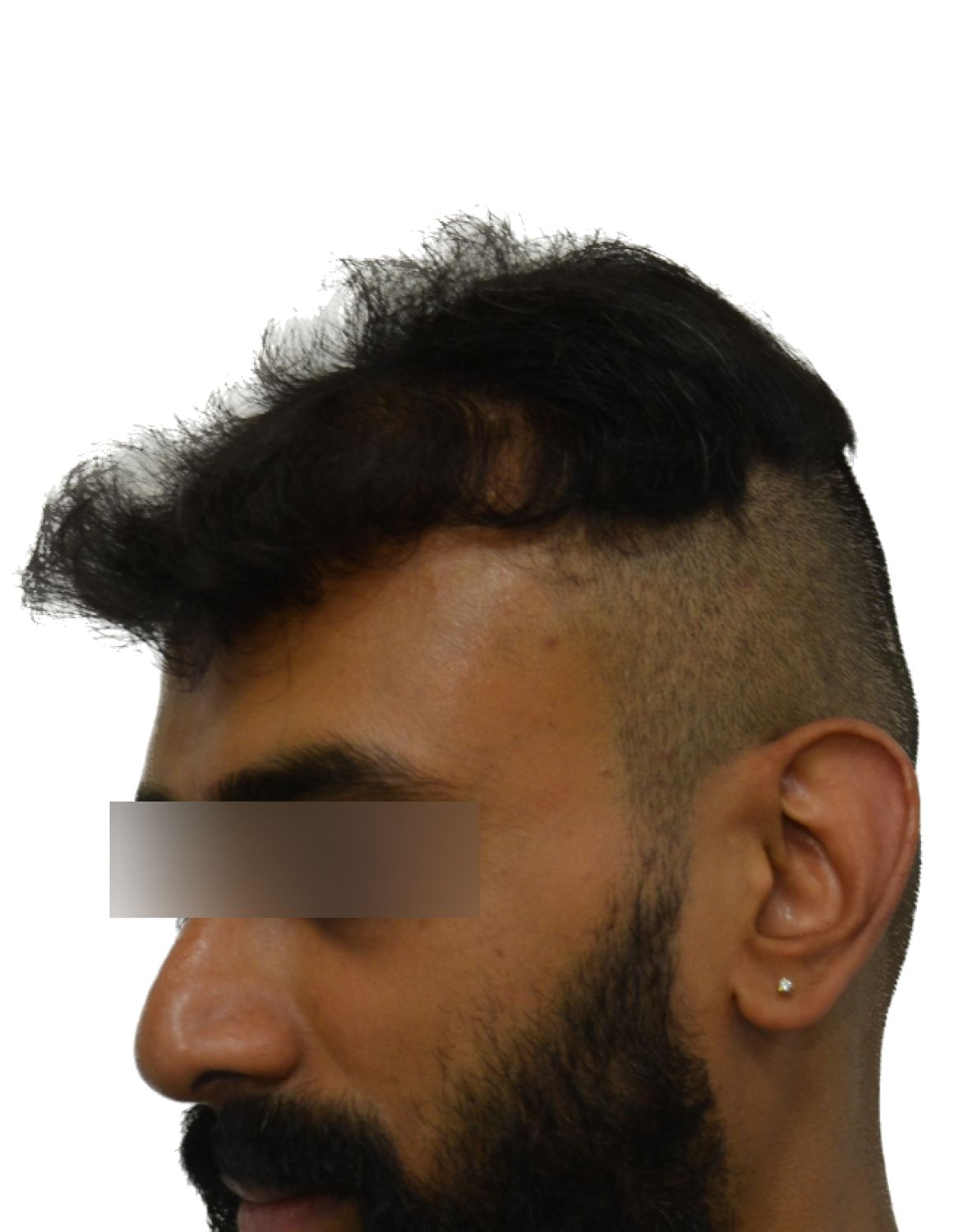 hair transplant before