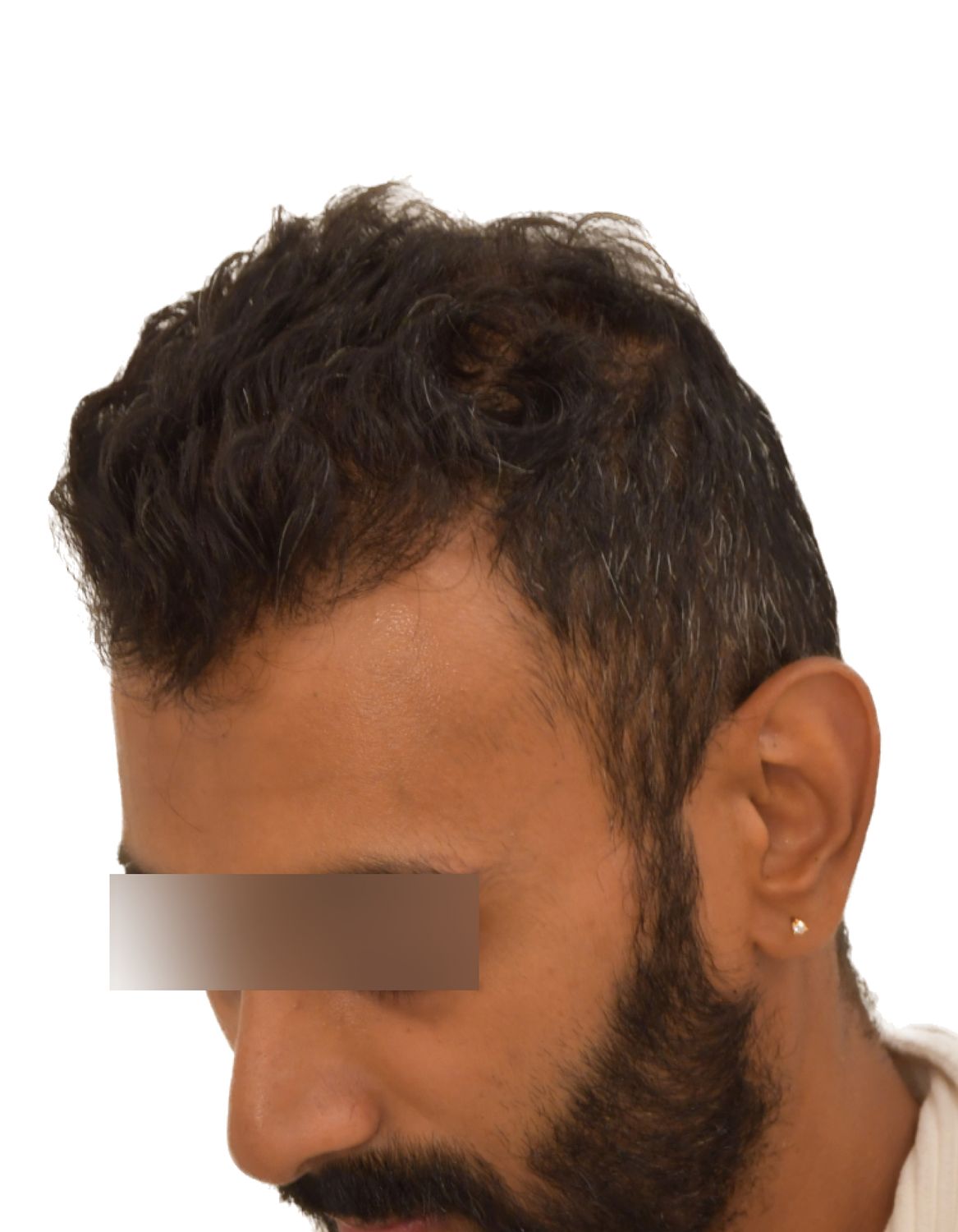 hair transplant after