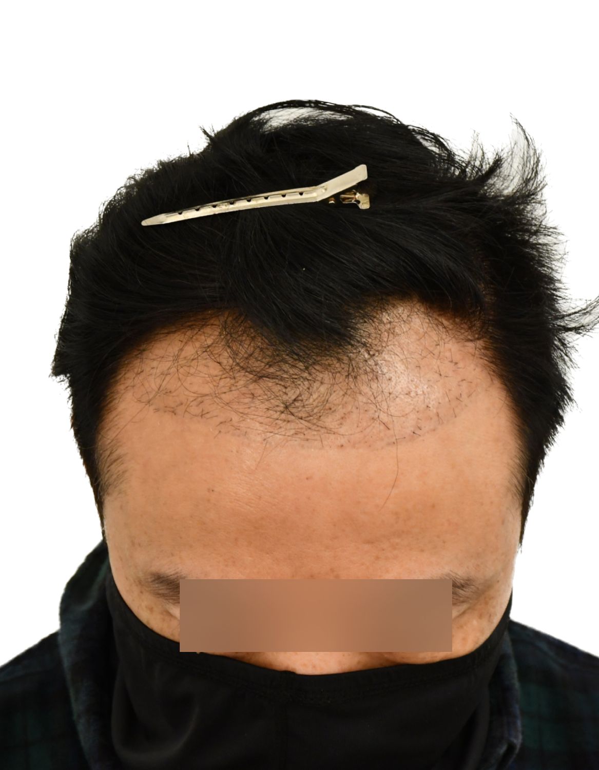 hair transplant before