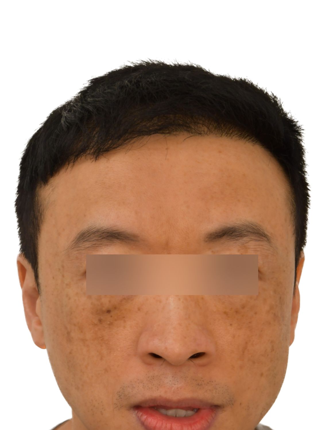 hair transplant after