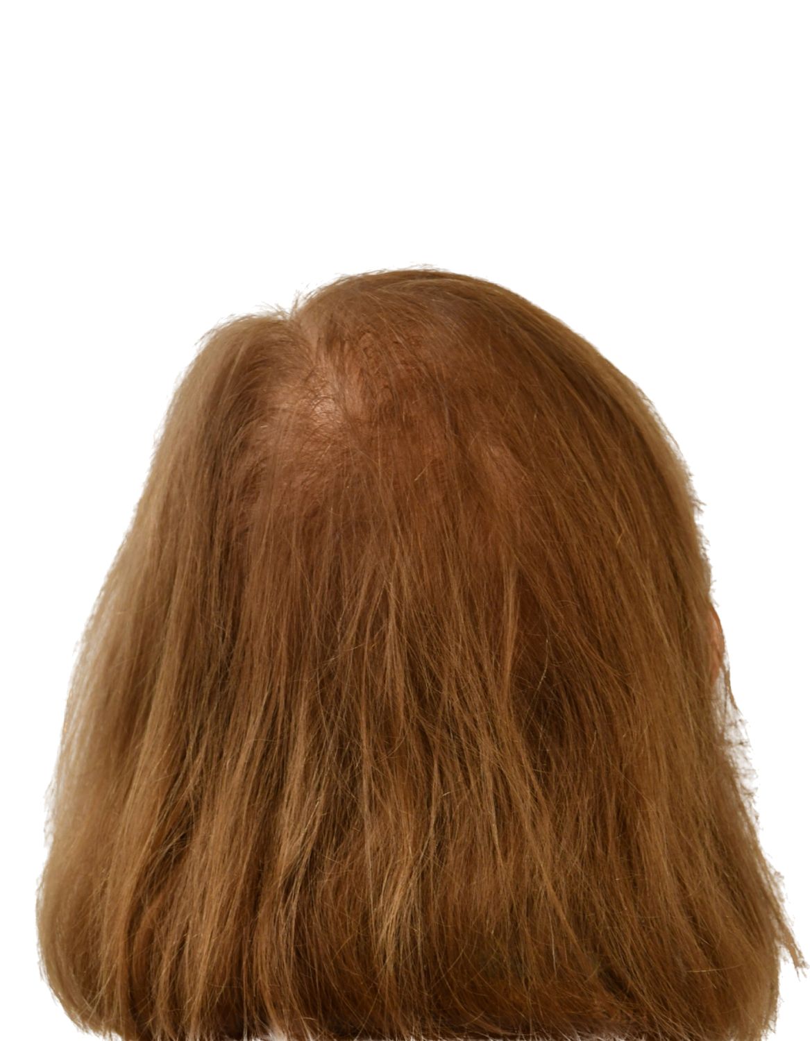 hair transplant after