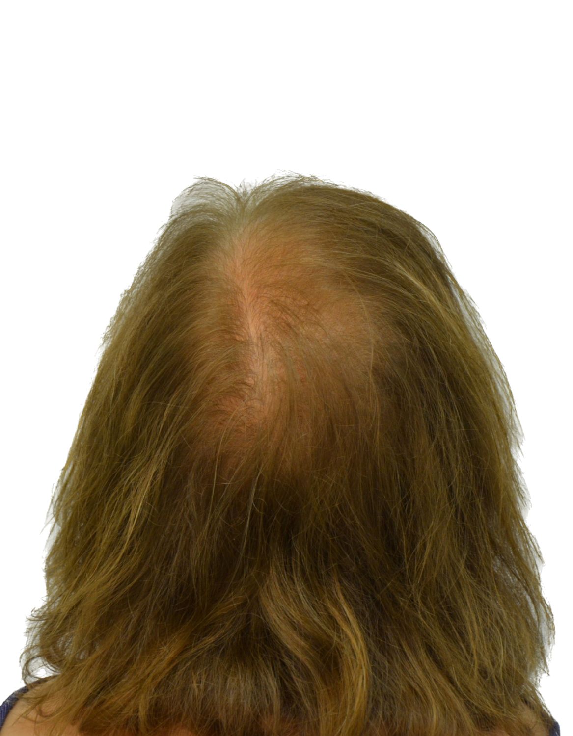 hair transplant before