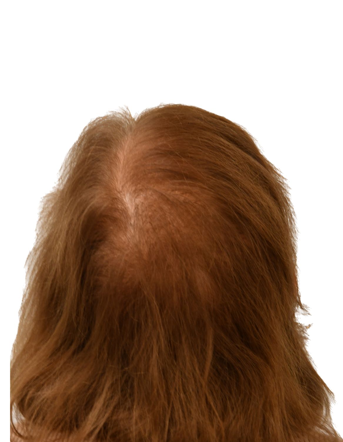 hair transplant after