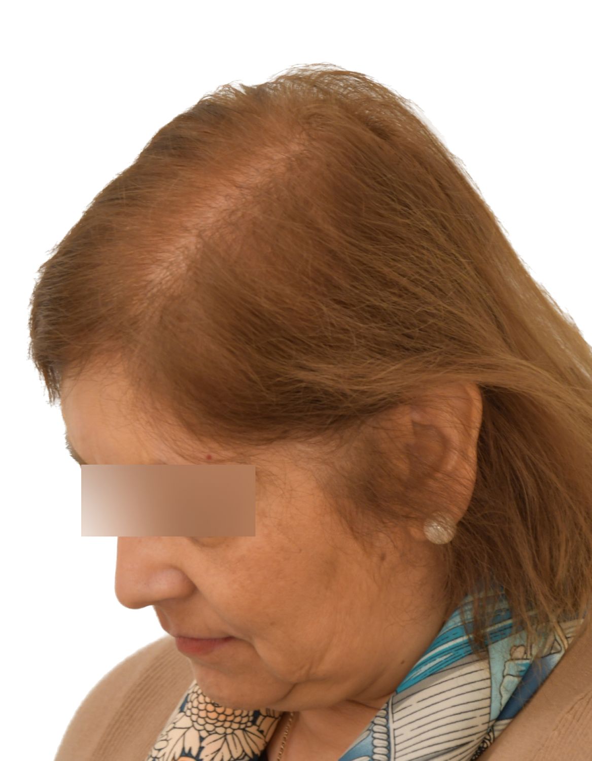 hair transplant after