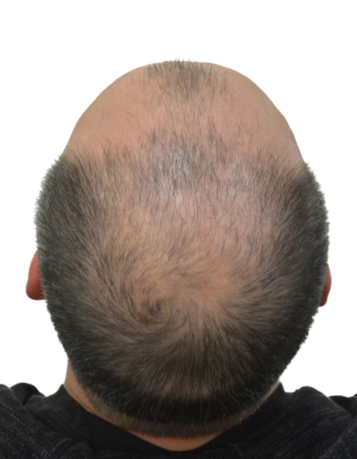 hair transplant before