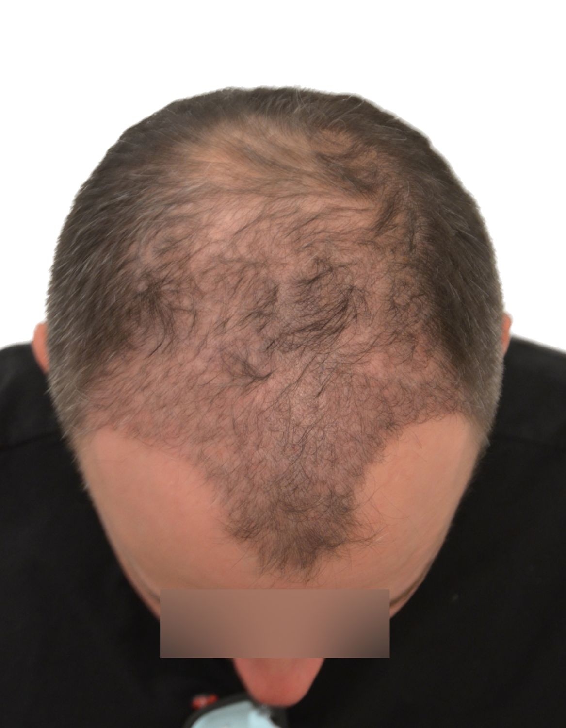 hair transplant after