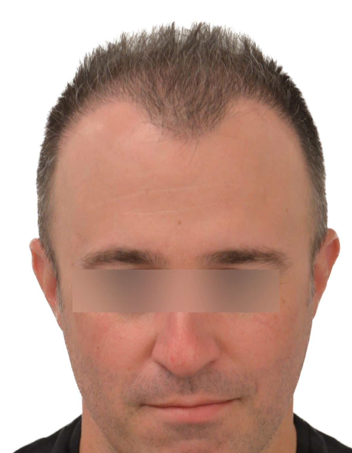 hair transplant after