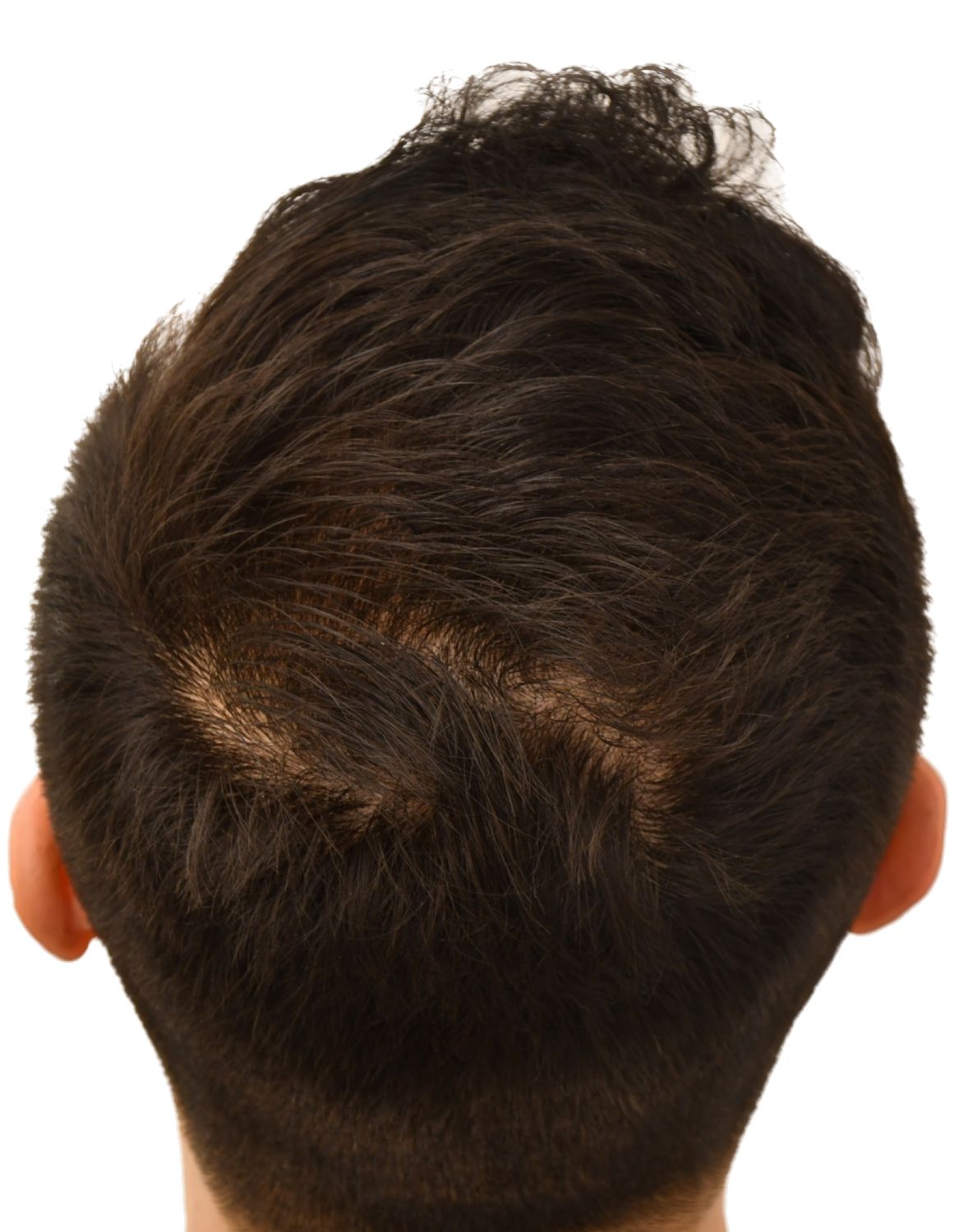 hair transplant after