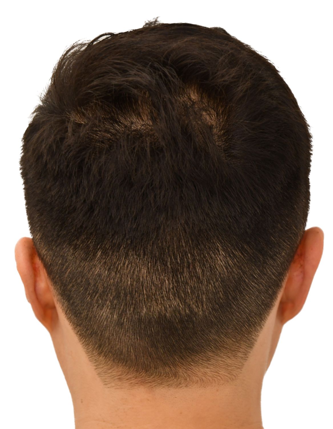 hair transplant after