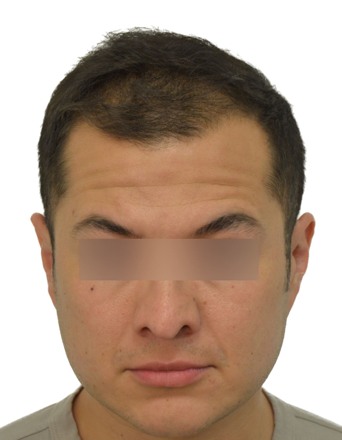 hair transplant before