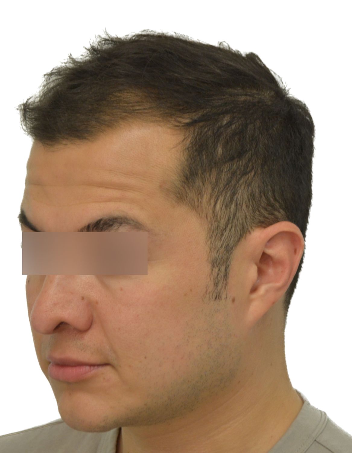 hair transplant before