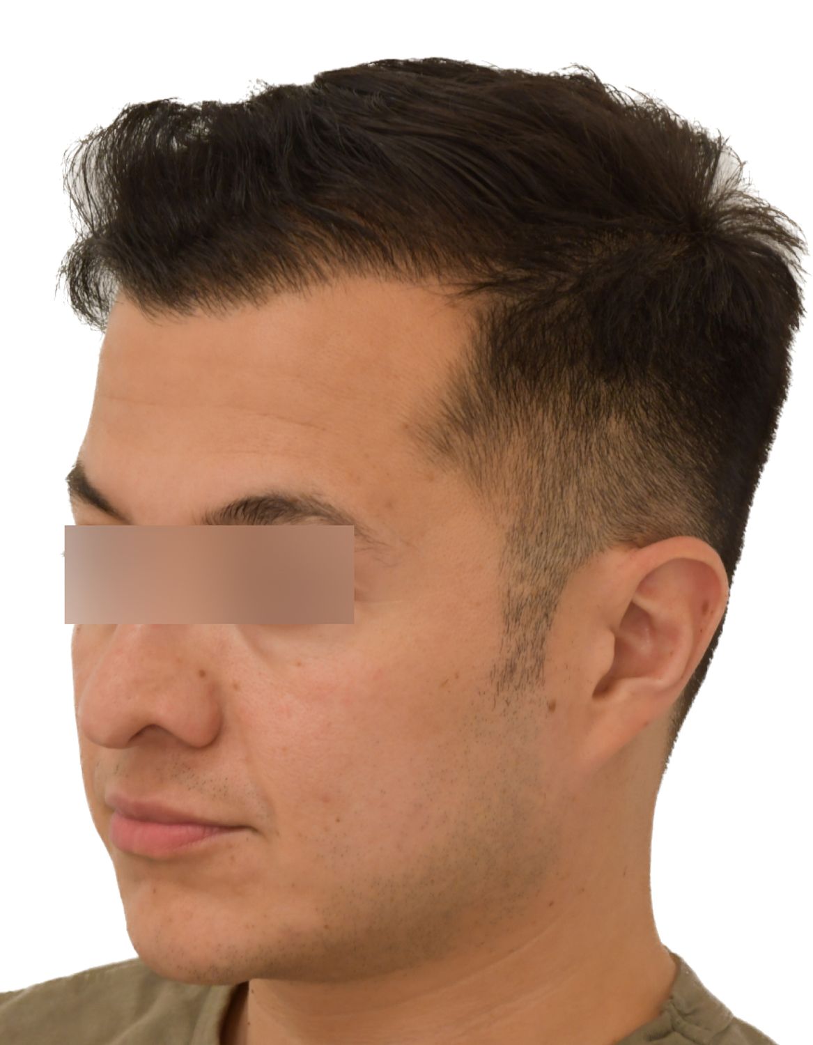 hair transplant after