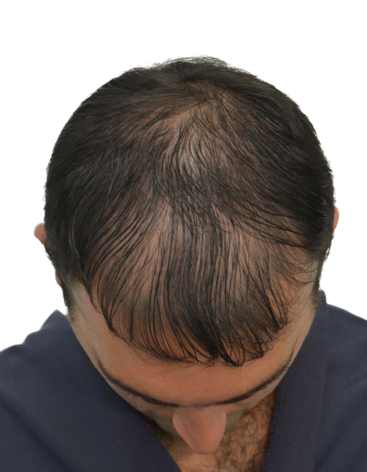 hair transplant before