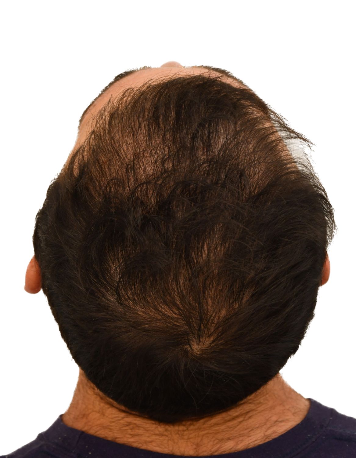 hair transplant after