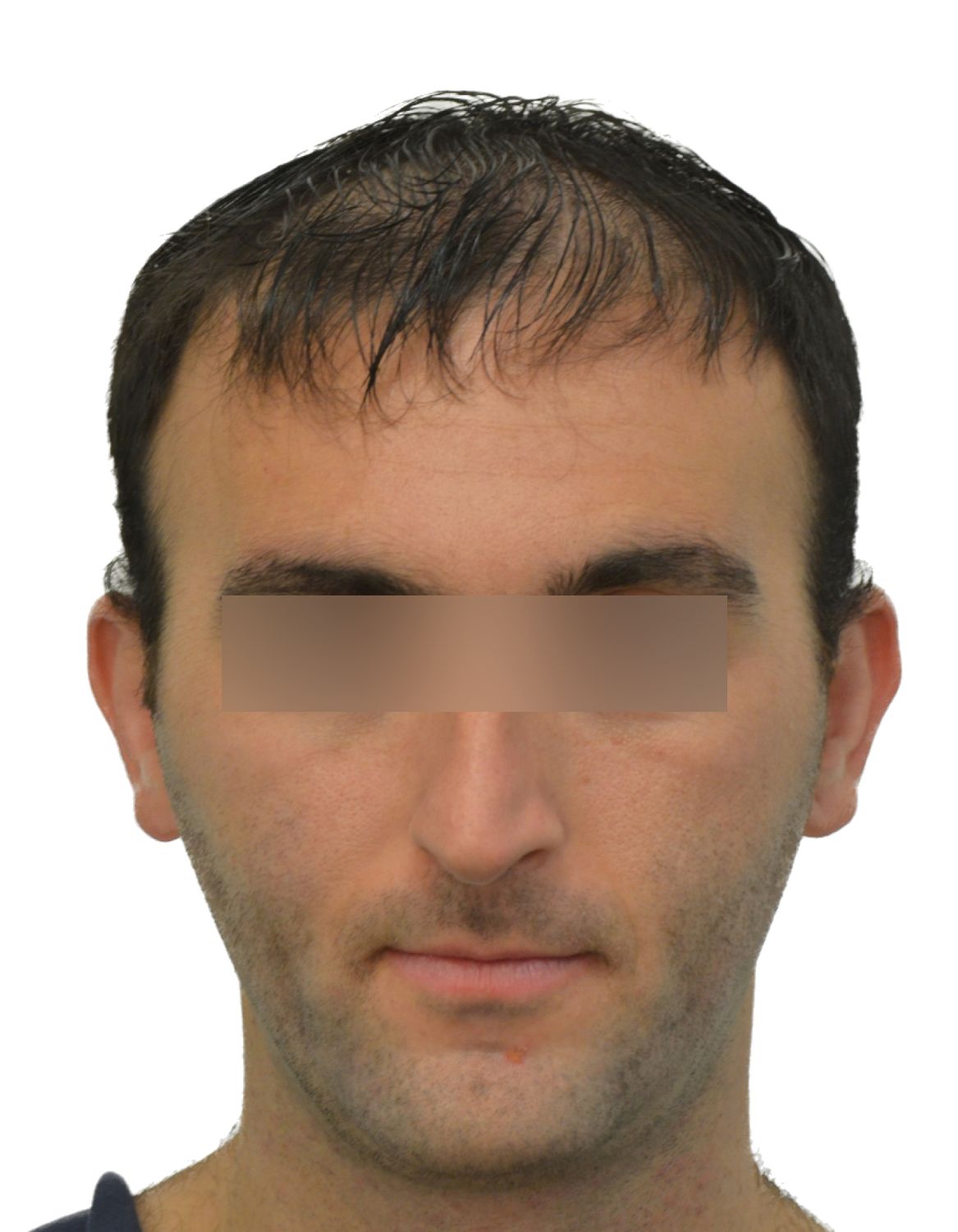 hair transplant before