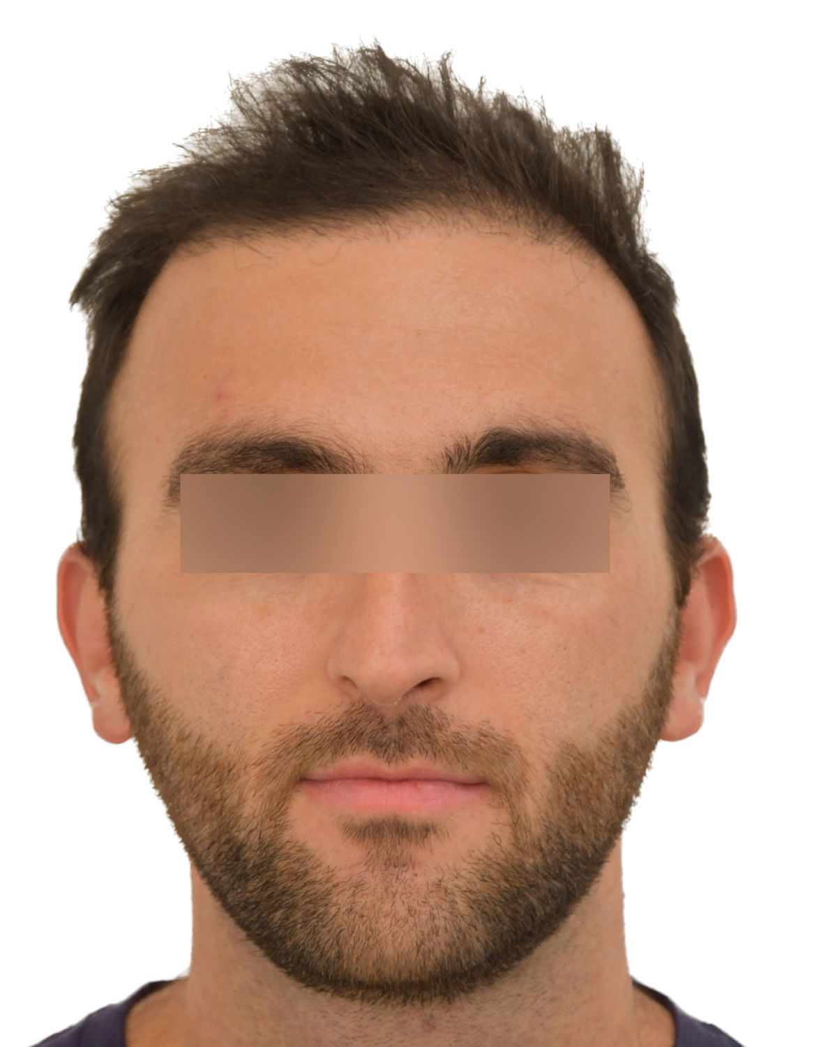 hair transplant after