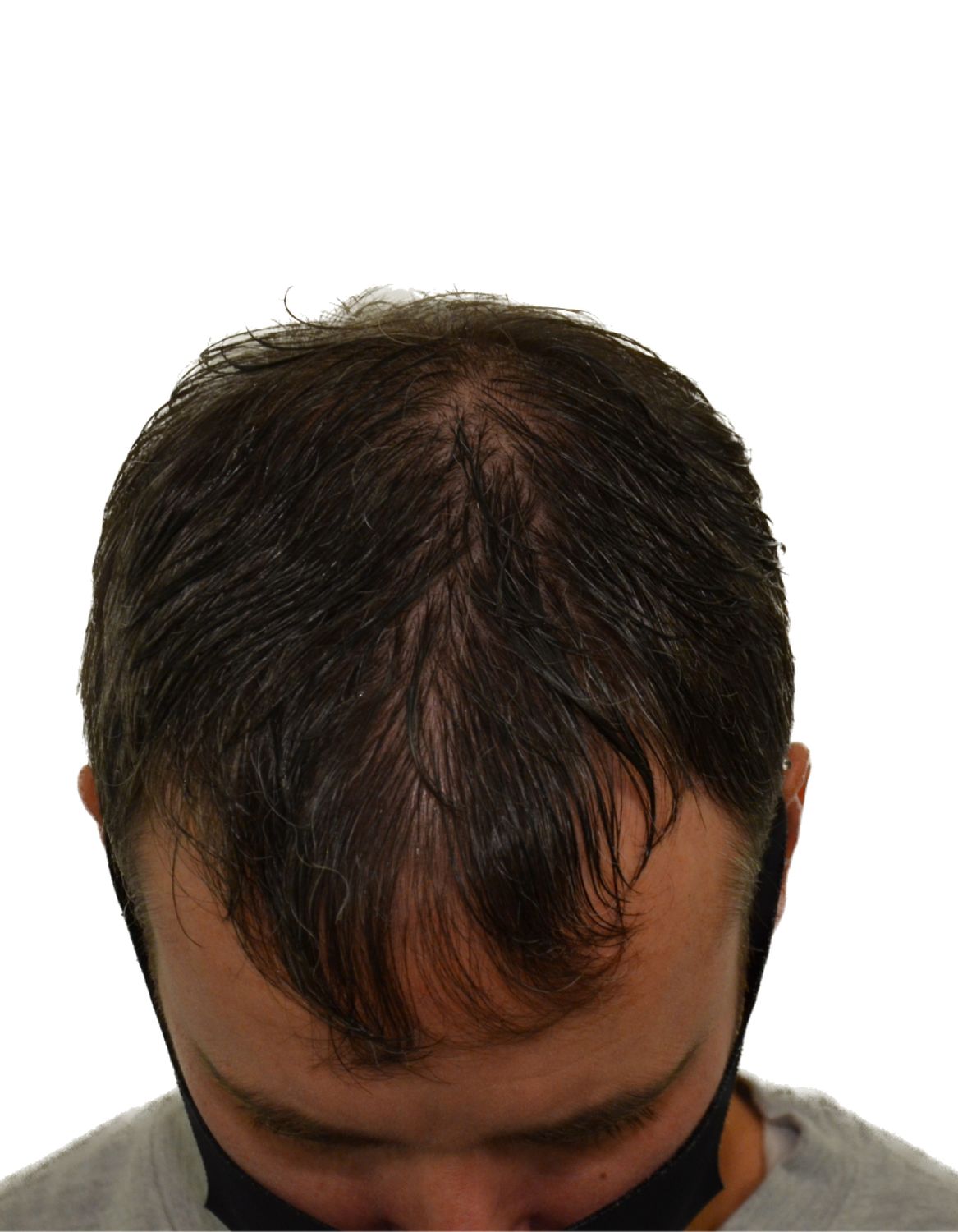hair transplant before