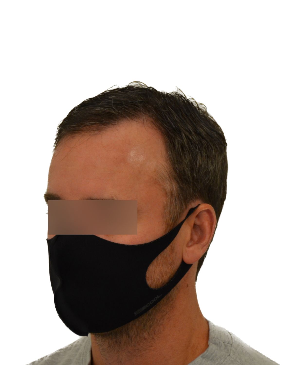 hair transplant before