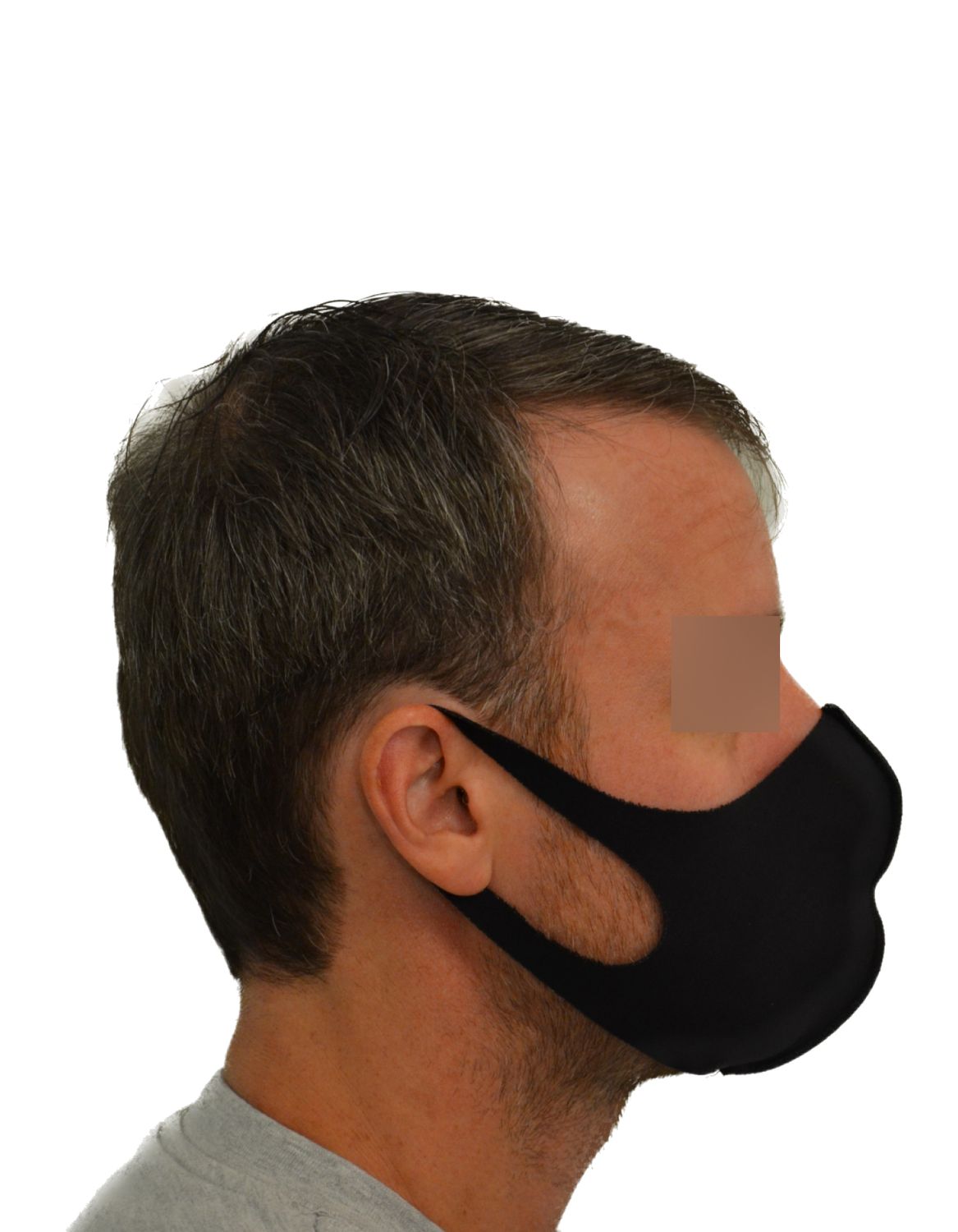 hair transplant before