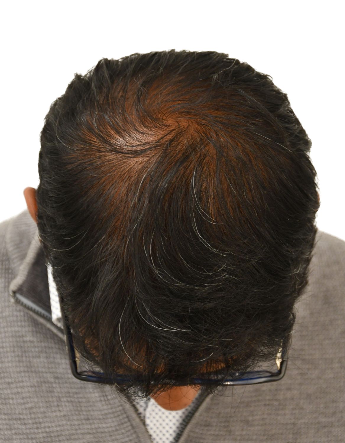 hair transplant after