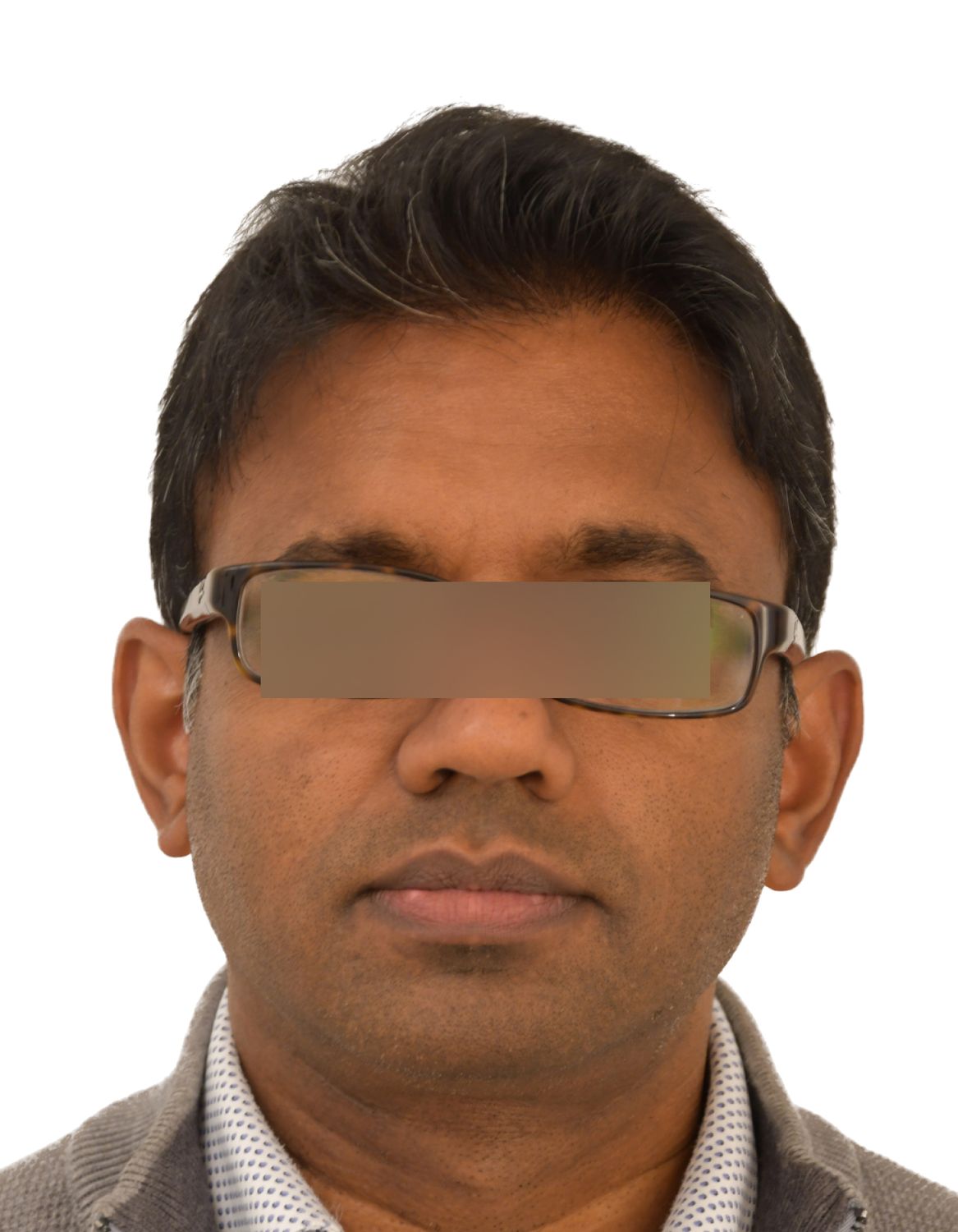 hair transplant after