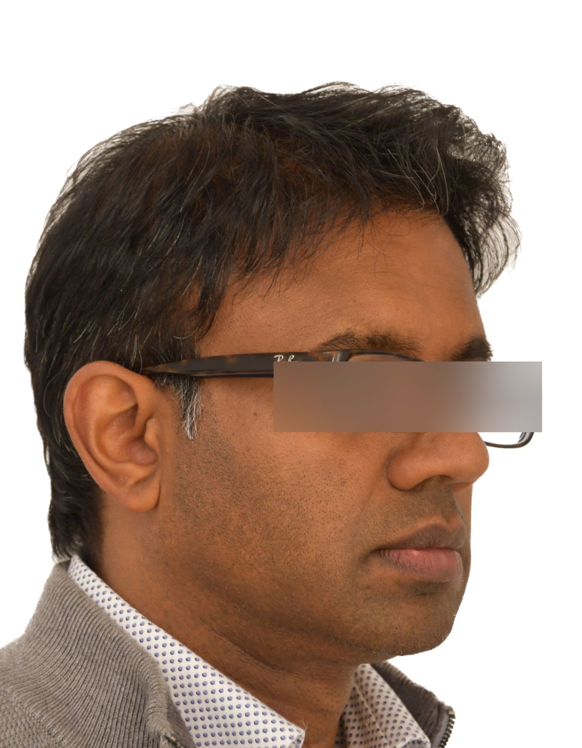 hair transplant after