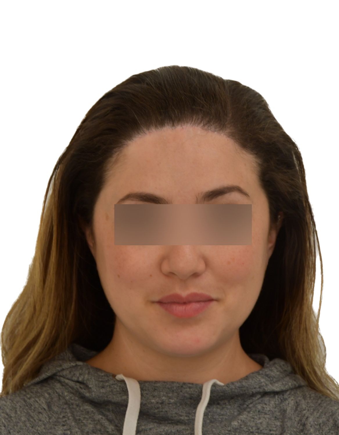 Forehead Reduction Surgery After