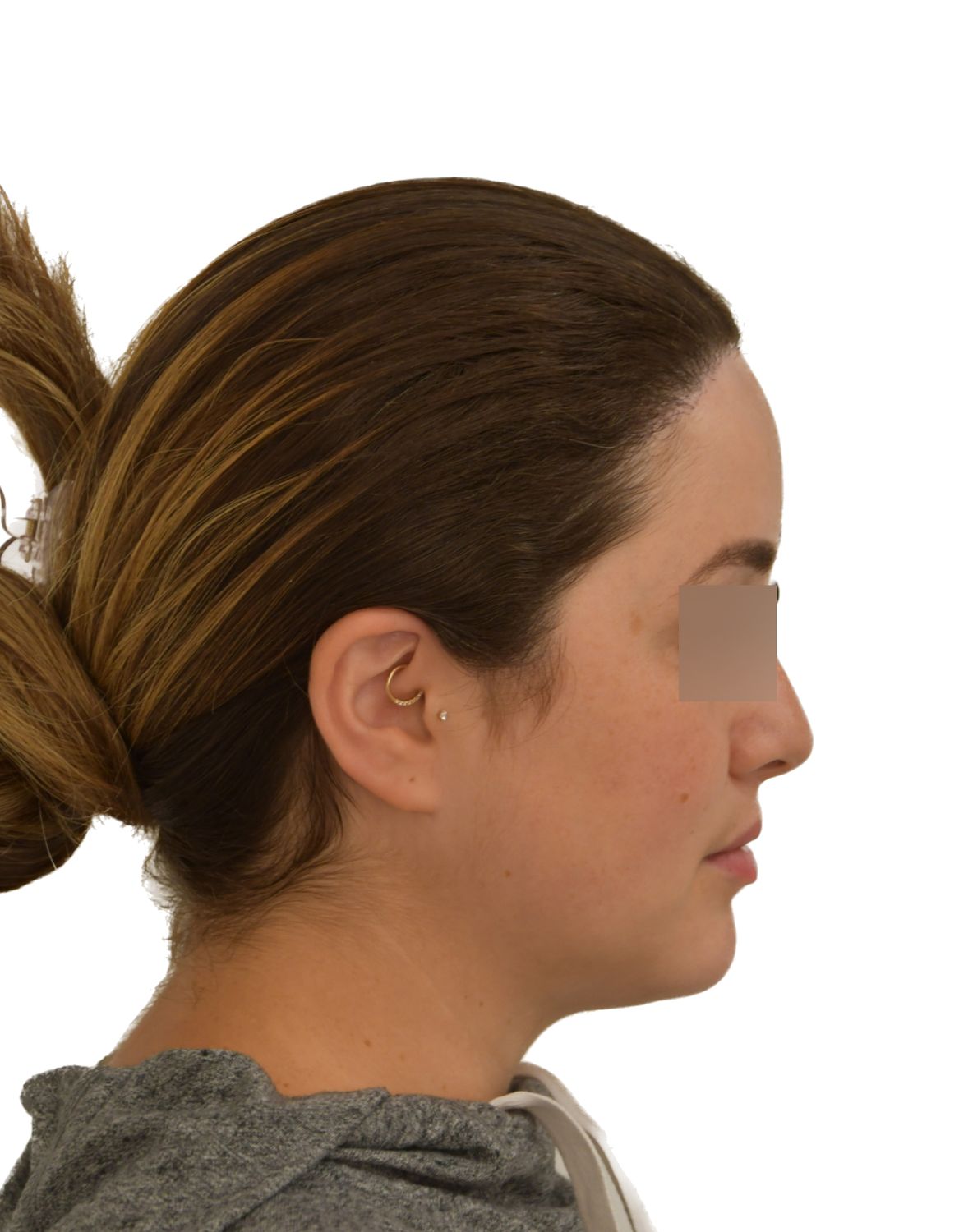 Forehead Reduction Surgery After