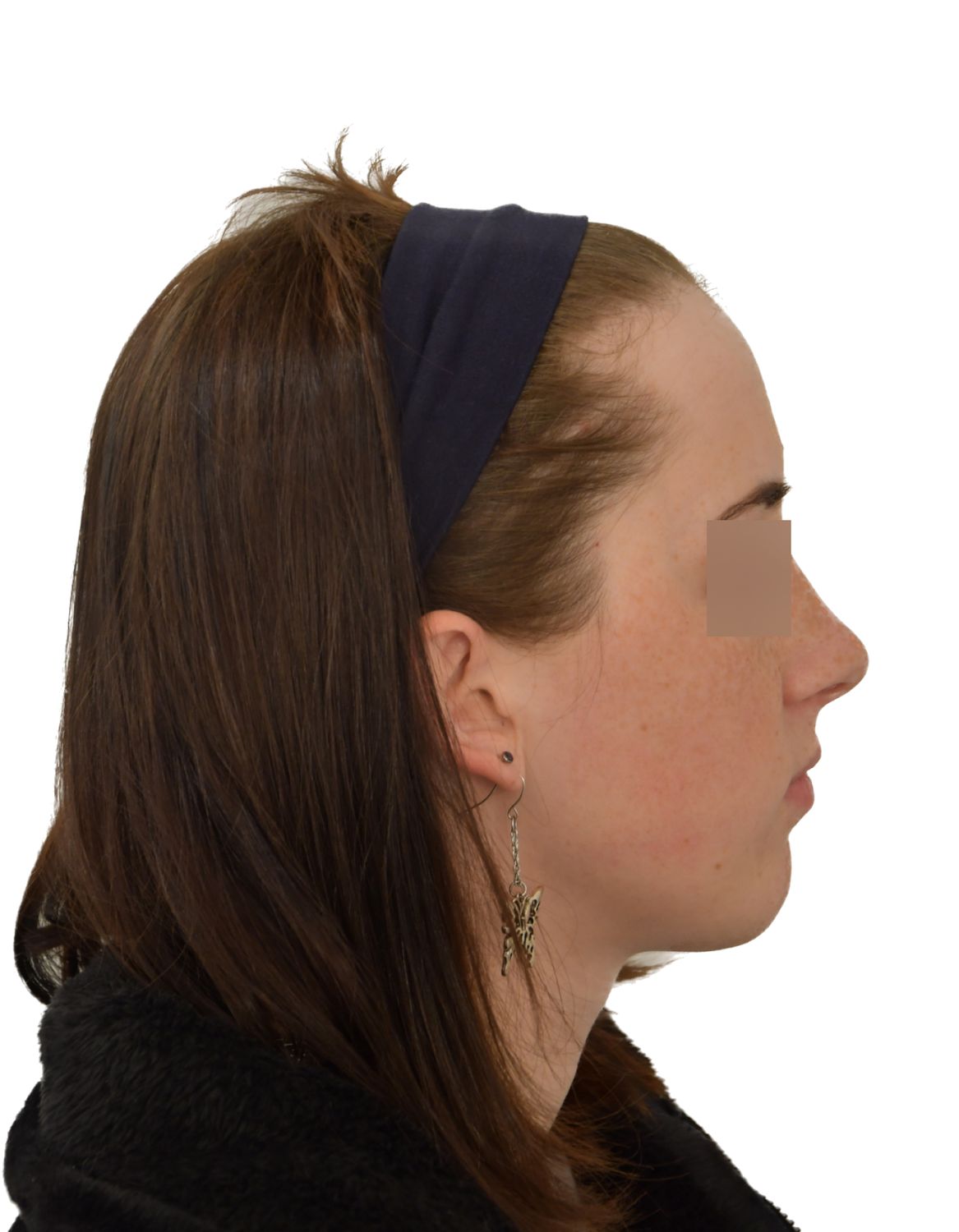 Forehead Reduction Surgery Before