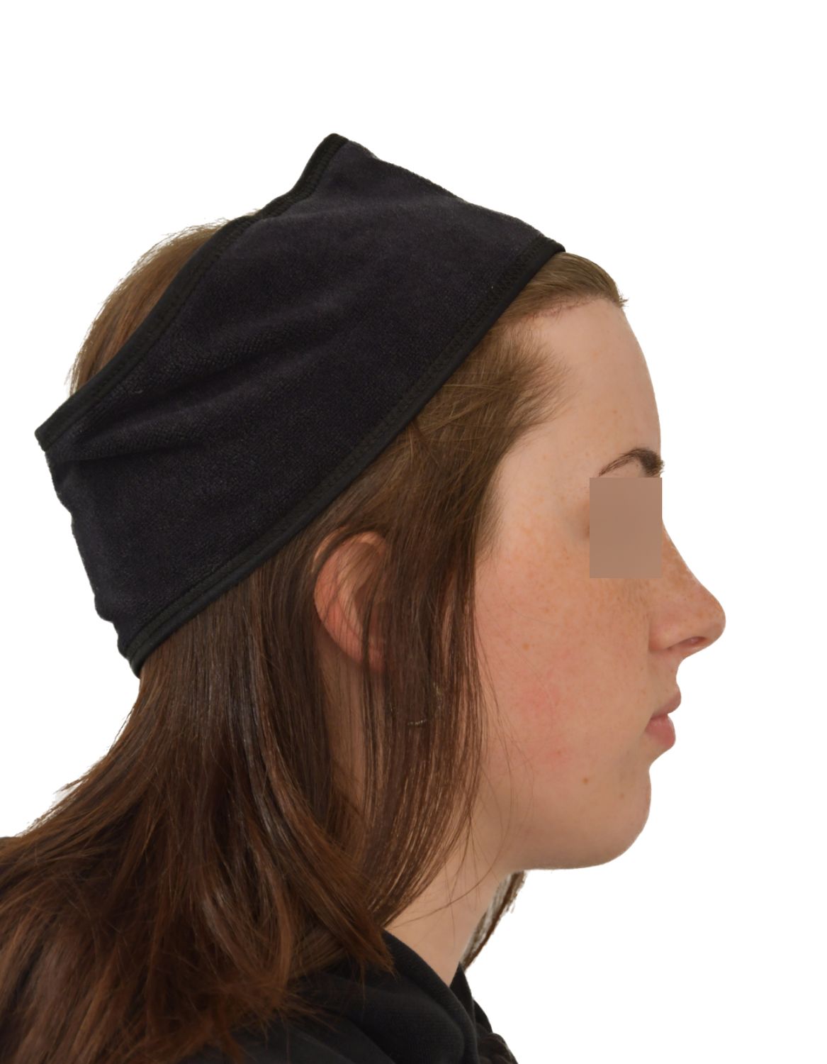 Forehead Reduction Surgery After