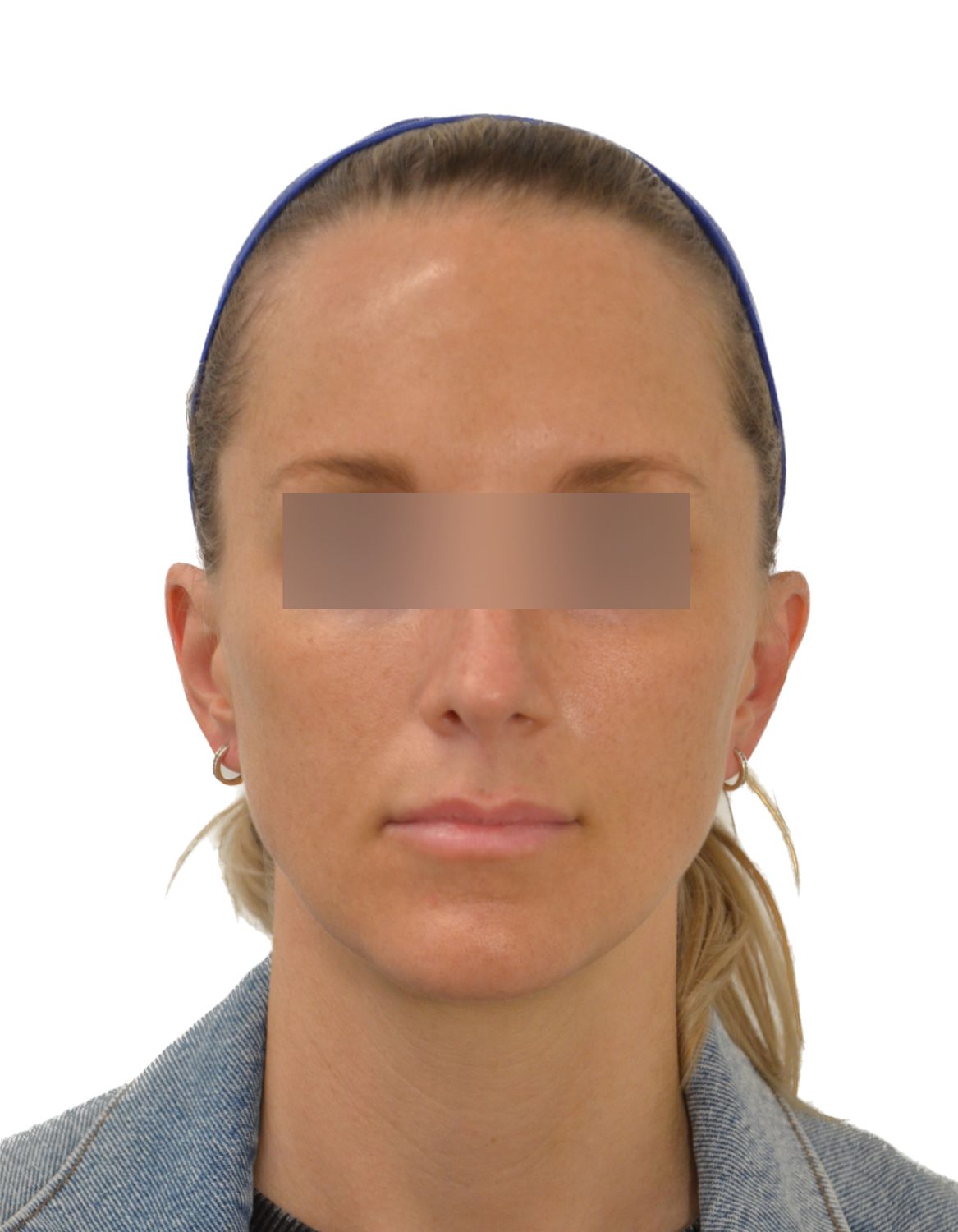 Forehead Reduction Surgery Before