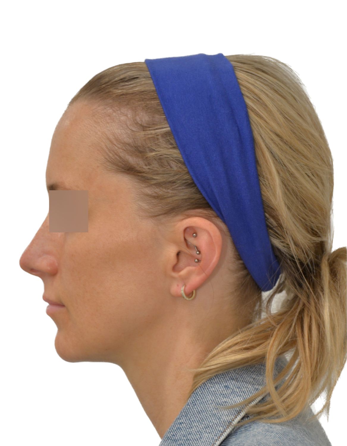 Forehead Reduction Surgery Before