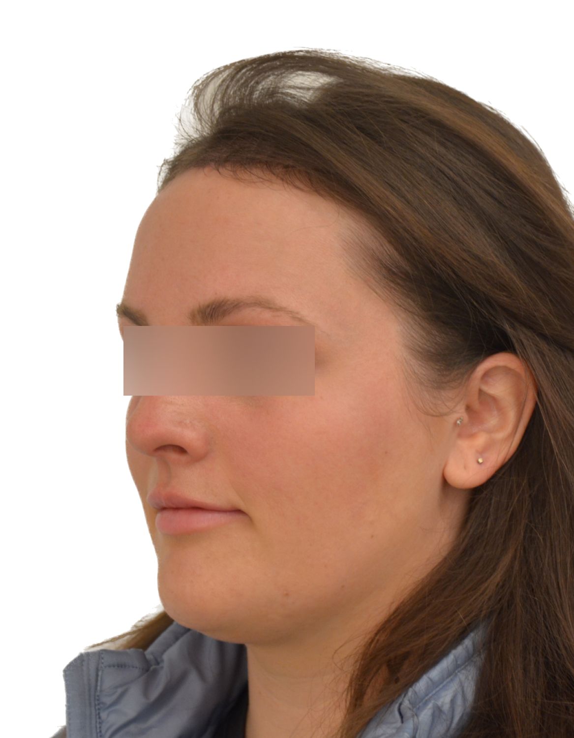Forehead Reduction Surgery After