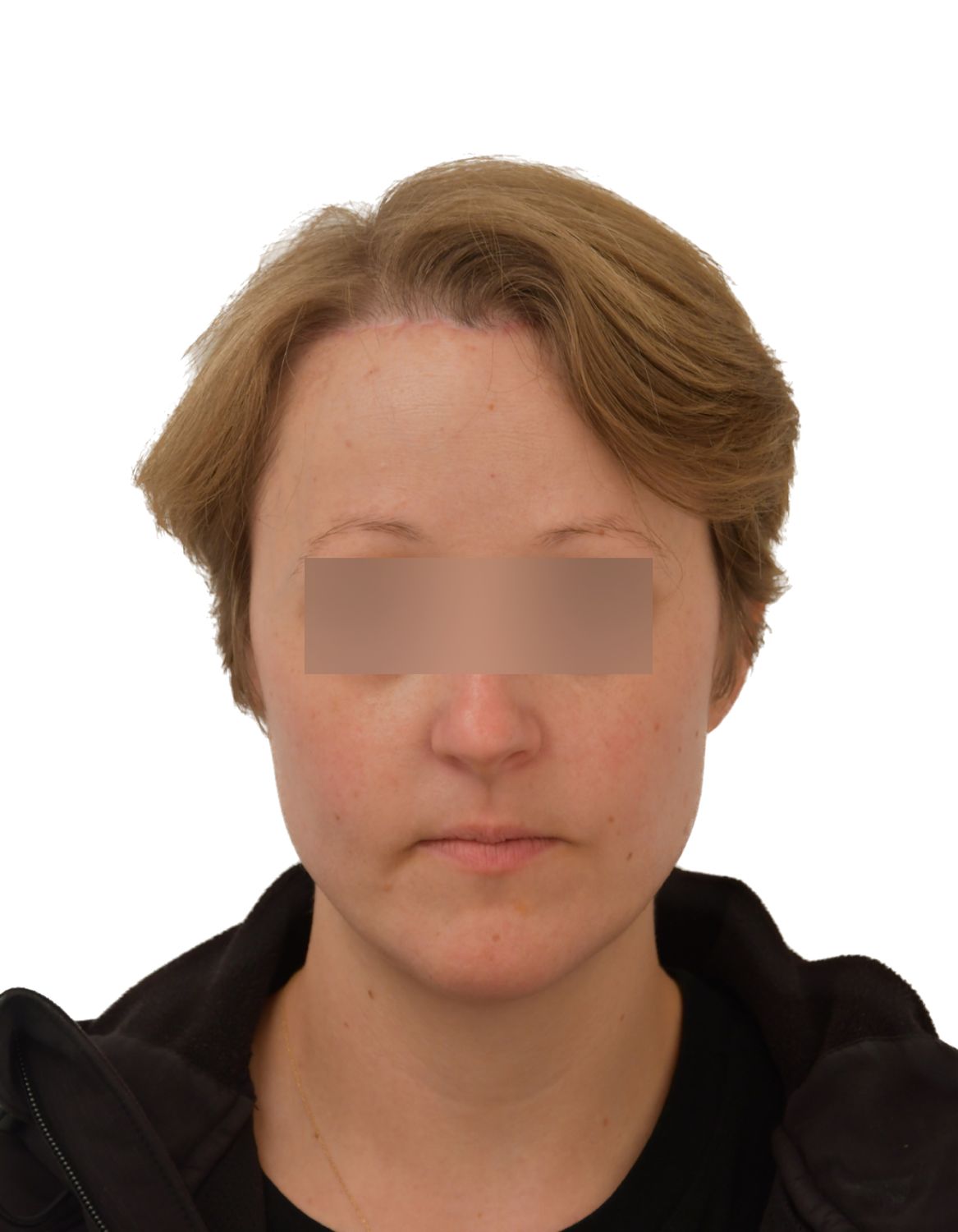 Forehead Reduction Surgery After