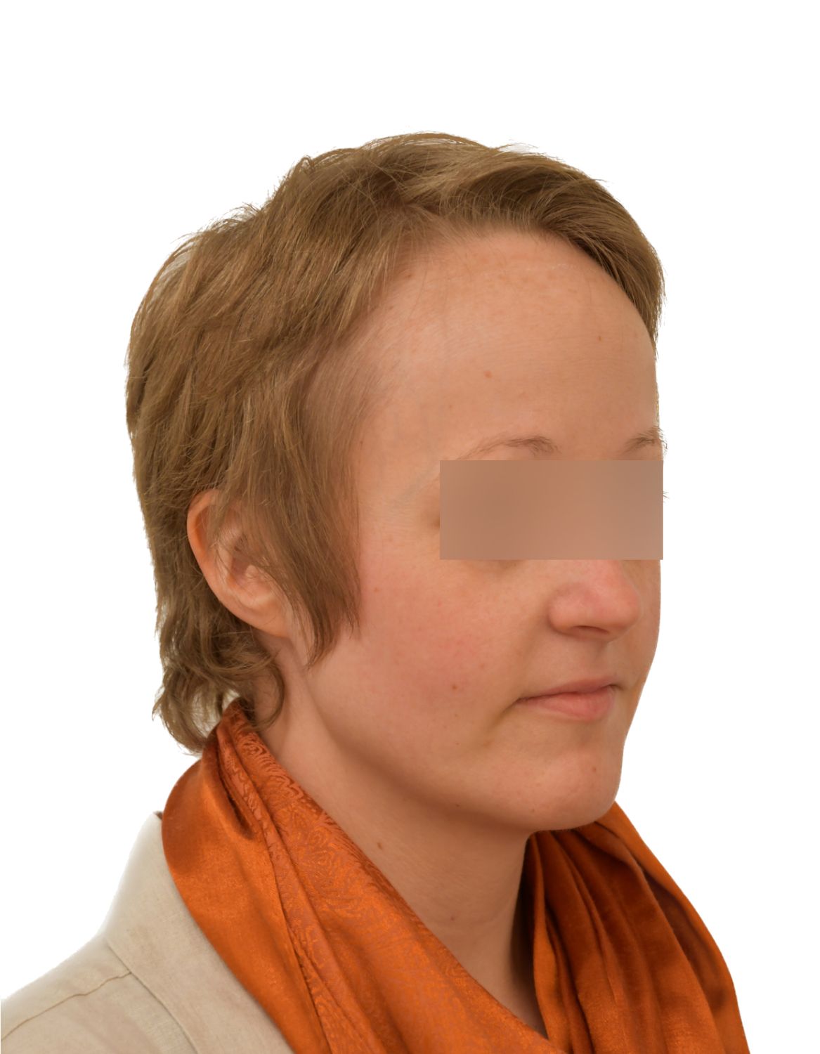 Forehead Reduction Surgery Before