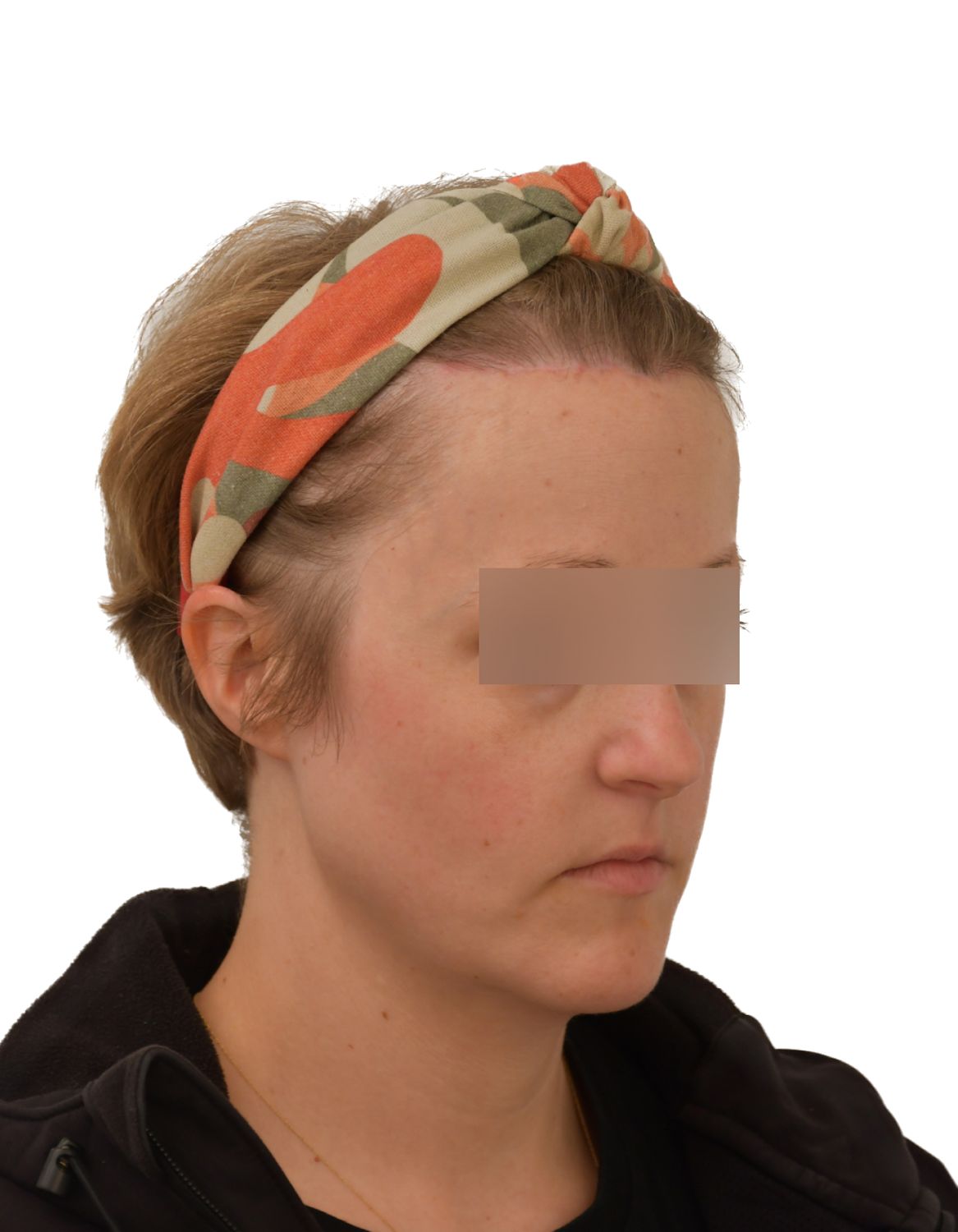 Forehead Reduction Surgery After