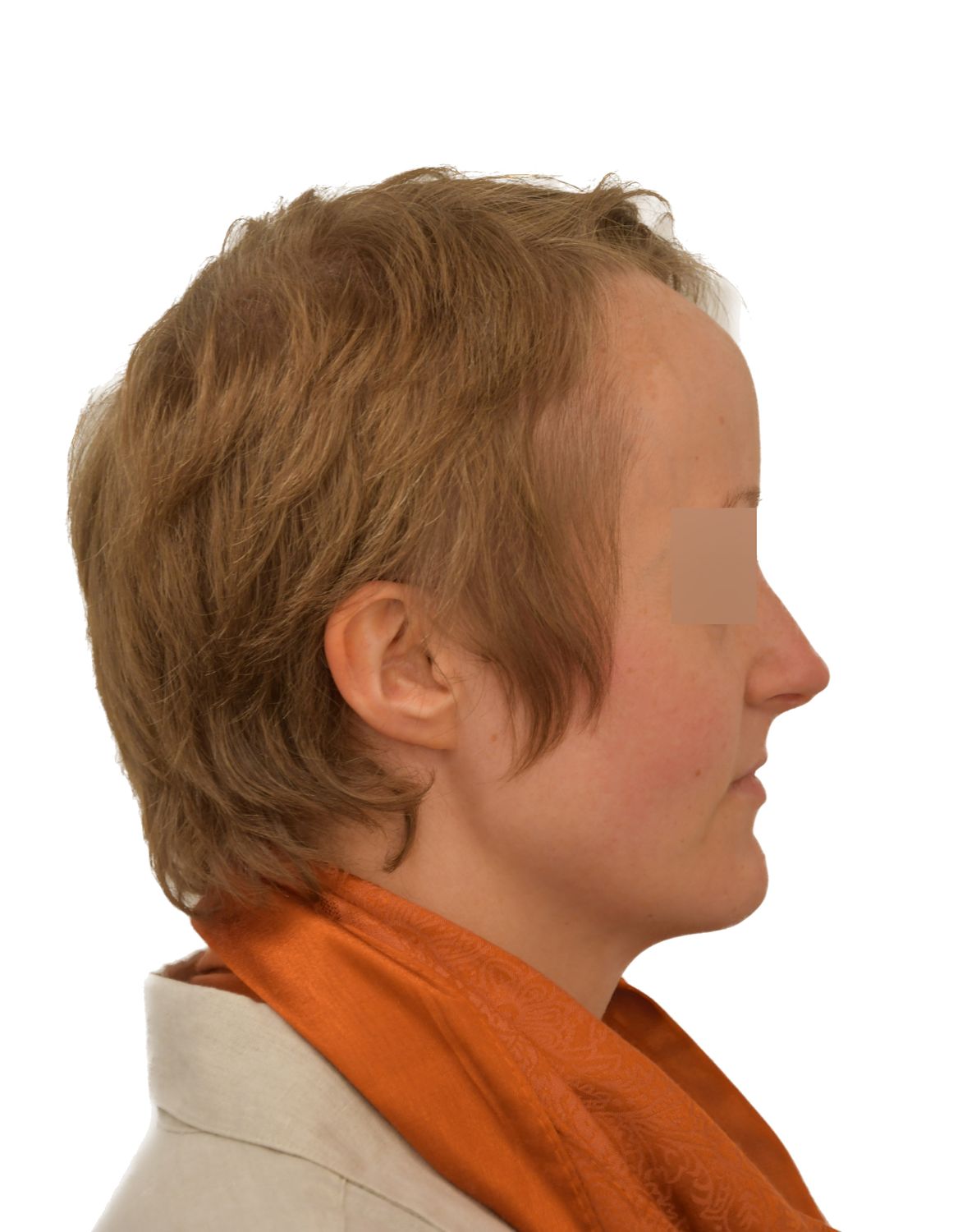 Forehead Reduction Surgery Before