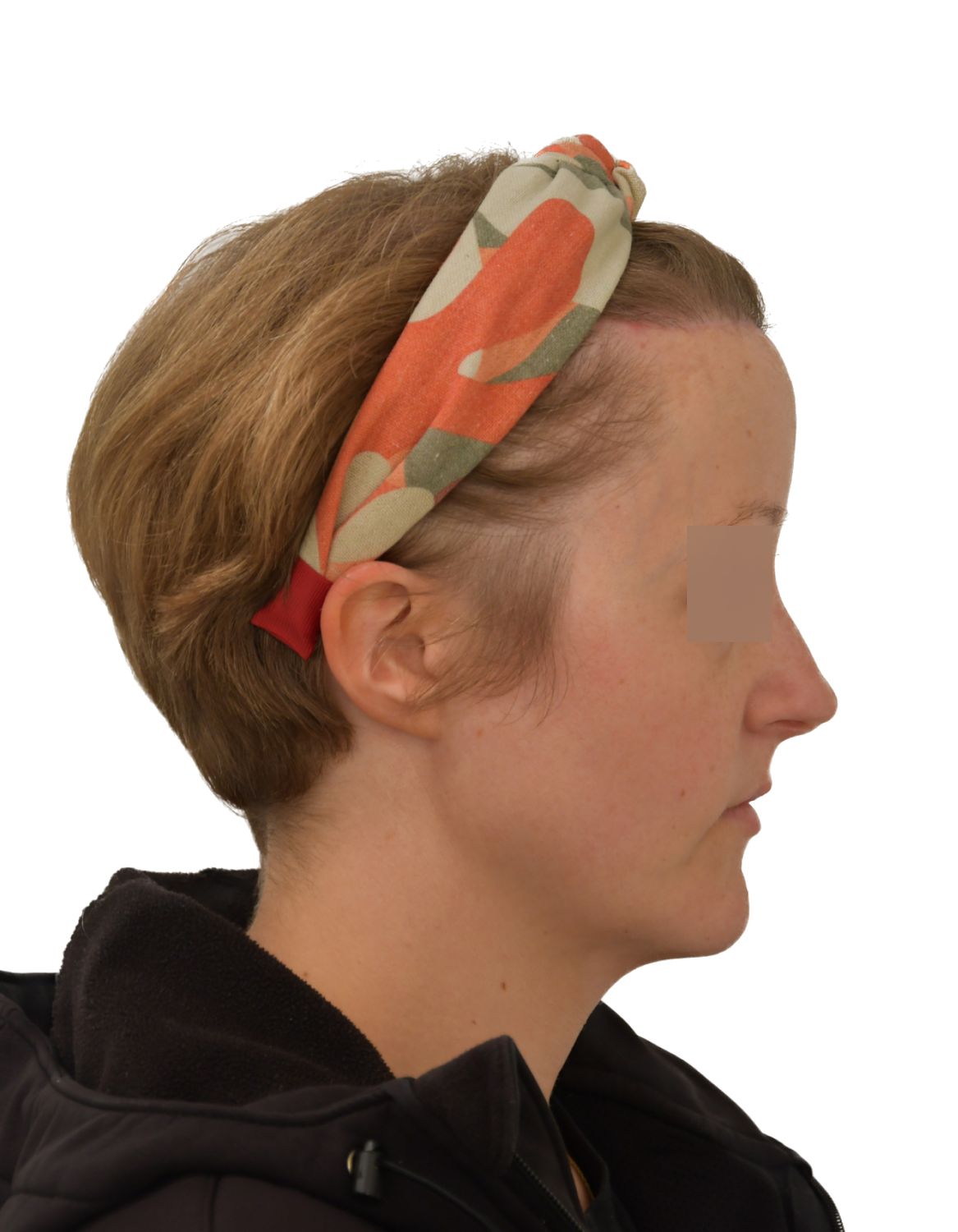 Forehead Reduction Surgery After