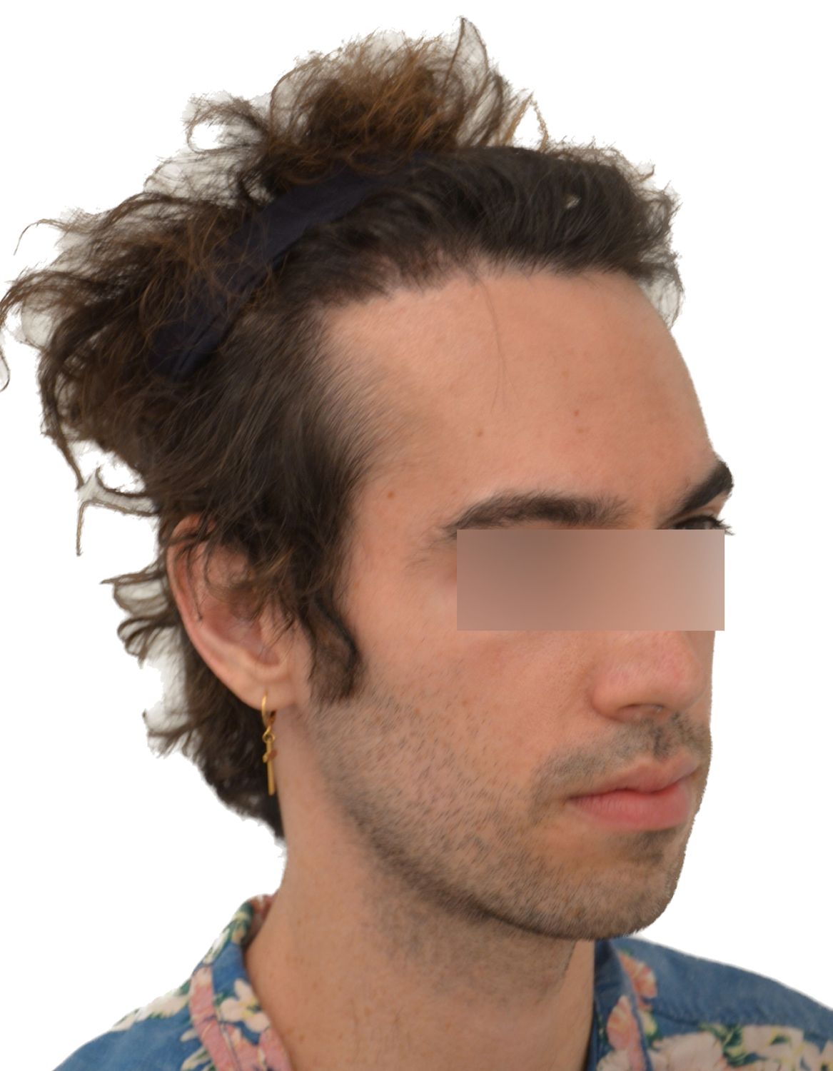 Forehead Reduction Surgery Before