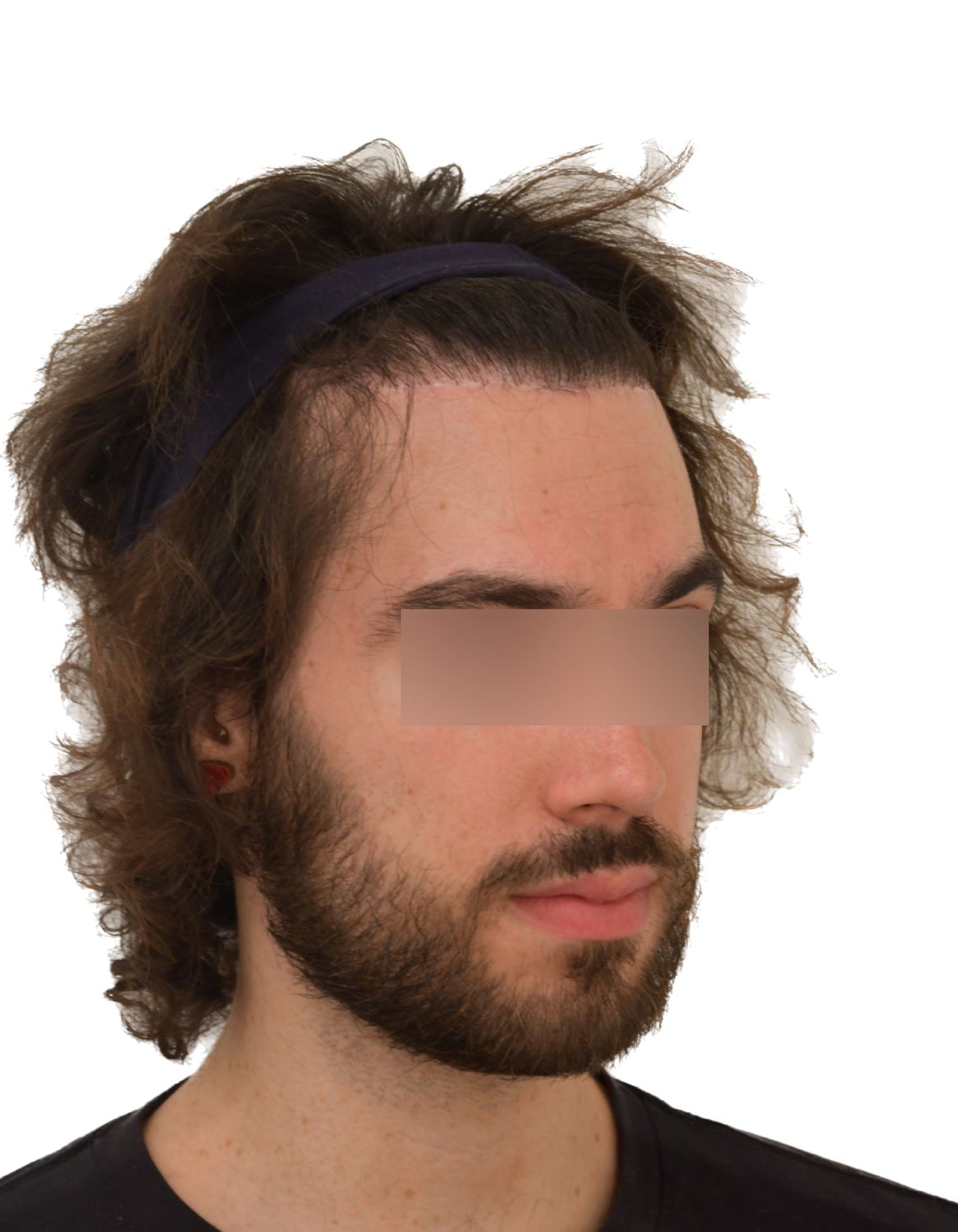 Forehead Reduction Surgery After