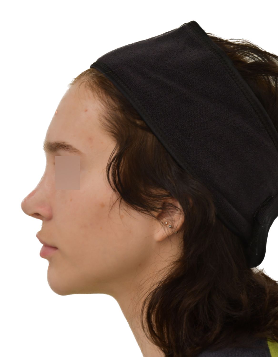 Forehead Reduction Surgery Before