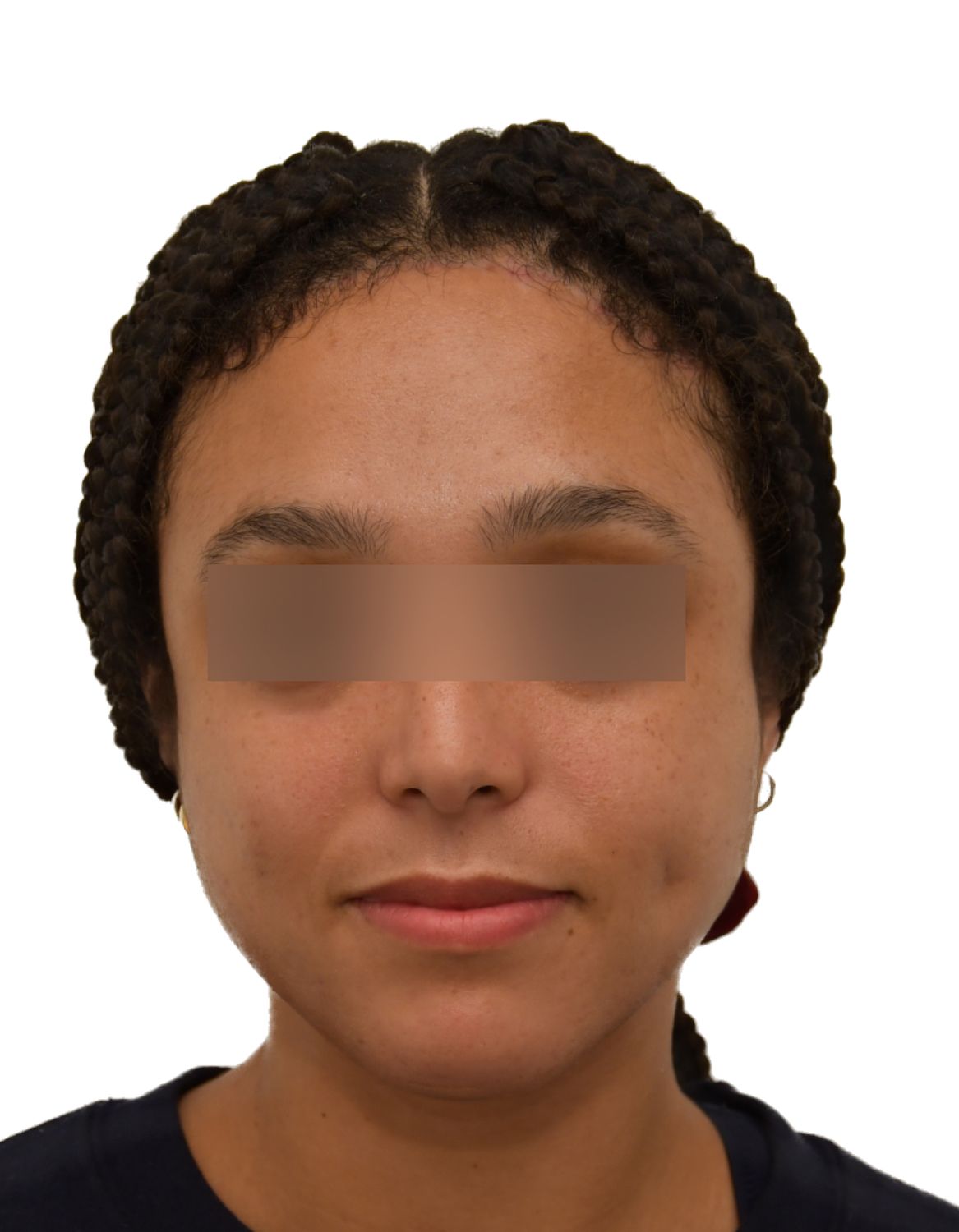 Forehead Reduction Surgery Before