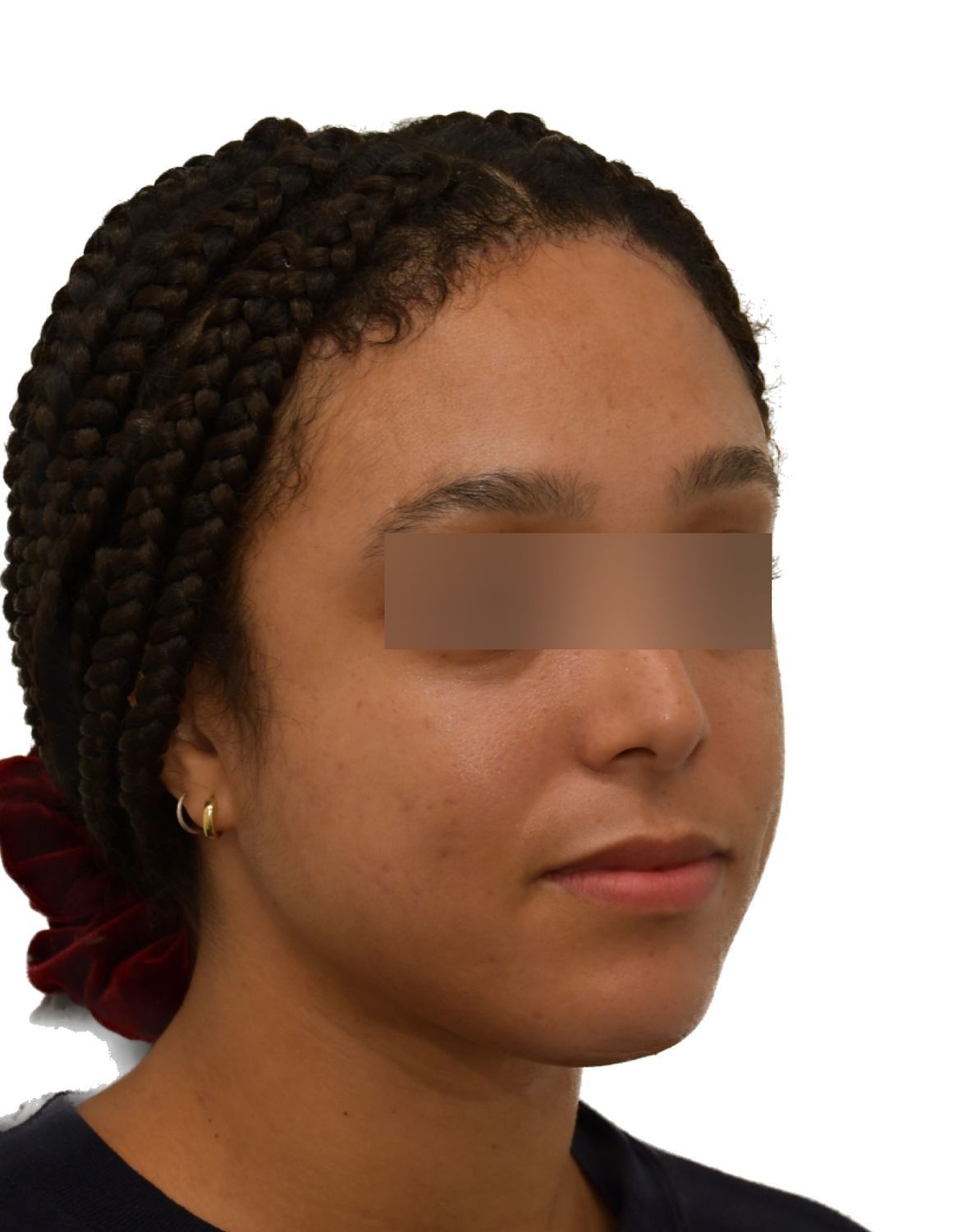 Forehead Reduction Surgery Before