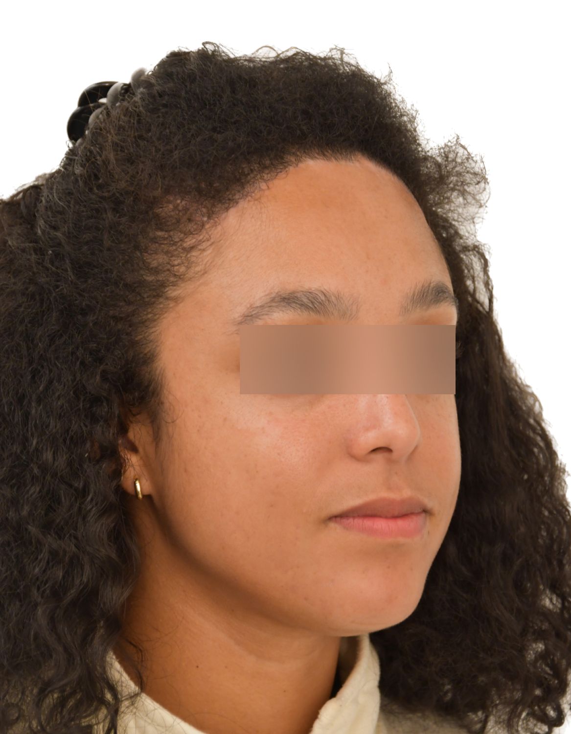 Forehead Reduction Surgery After