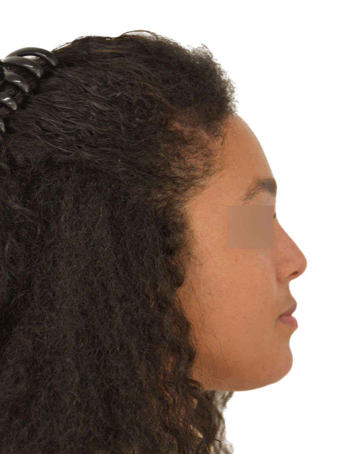 Forehead Reduction Surgery After