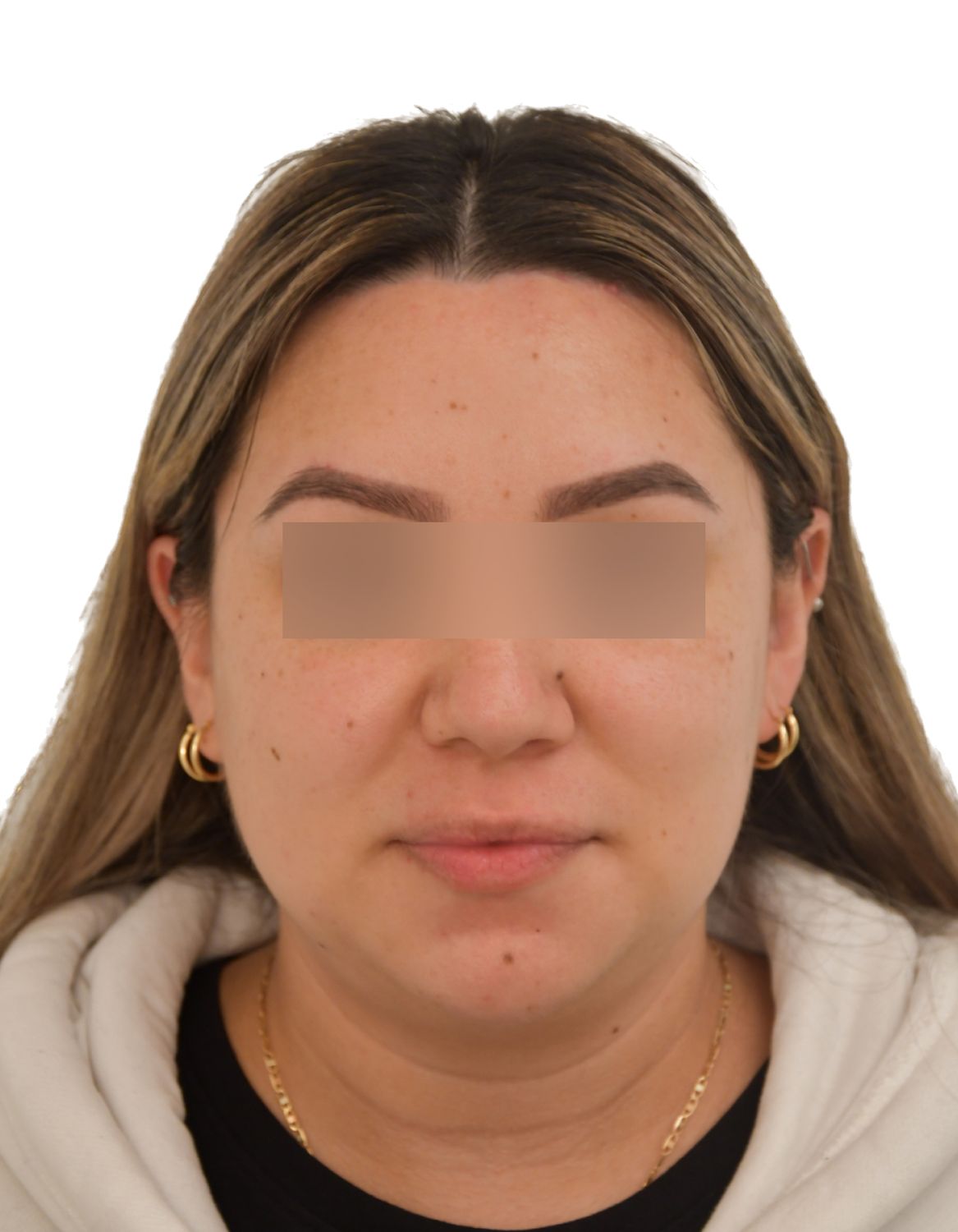Forehead Reduction Surgery After