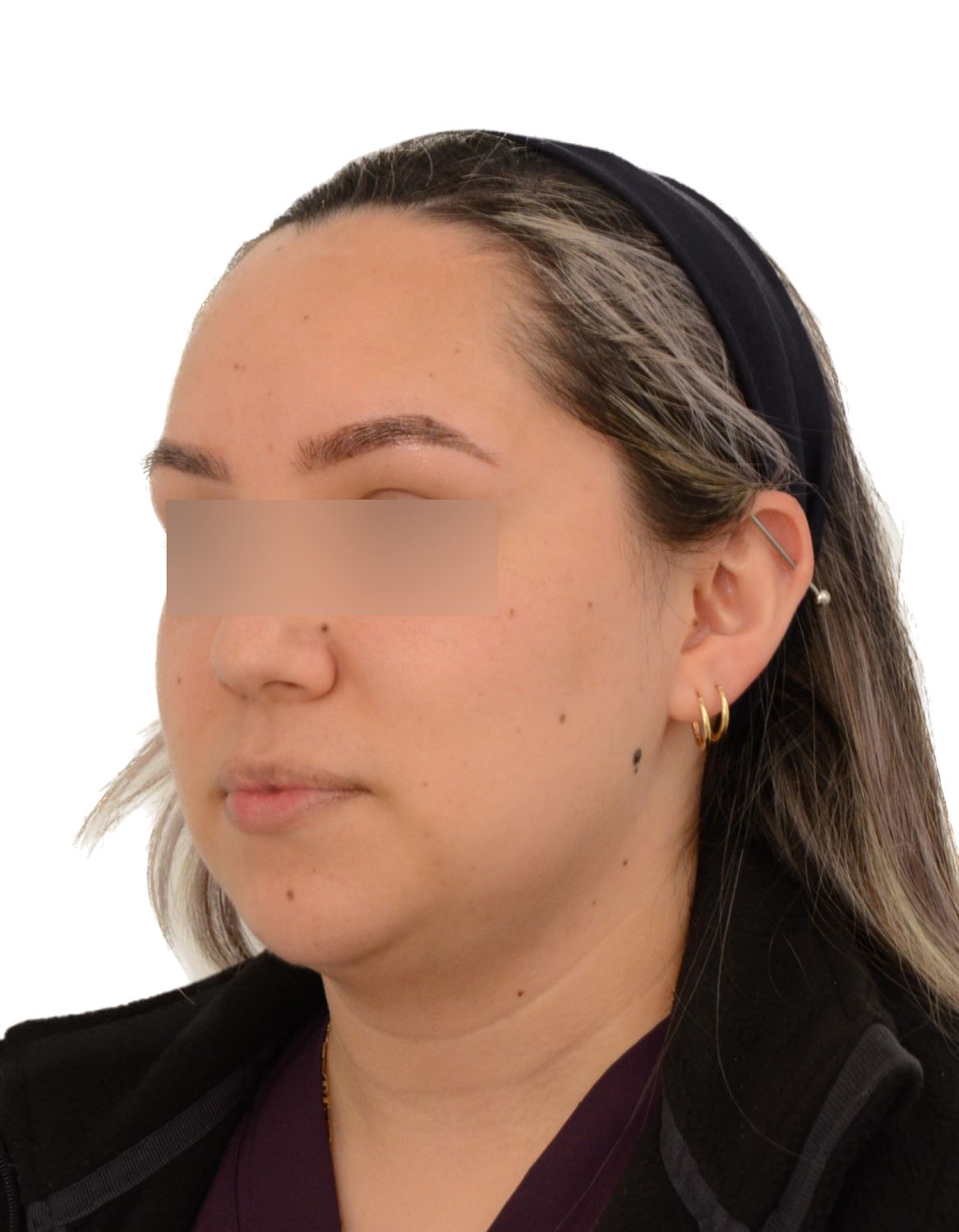 Forehead Reduction Surgery Before