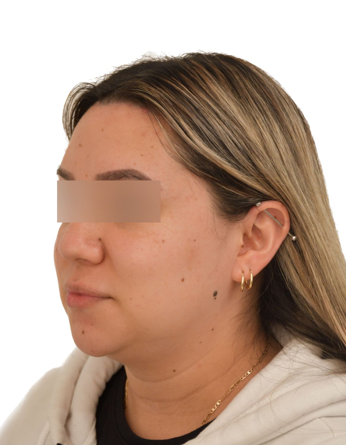 Forehead Reduction Surgery After